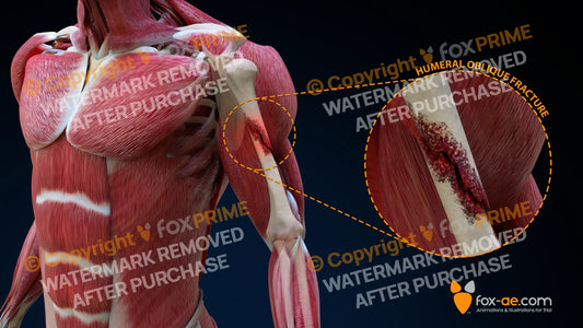 Left Humeral Oblique Fracture Still Shot