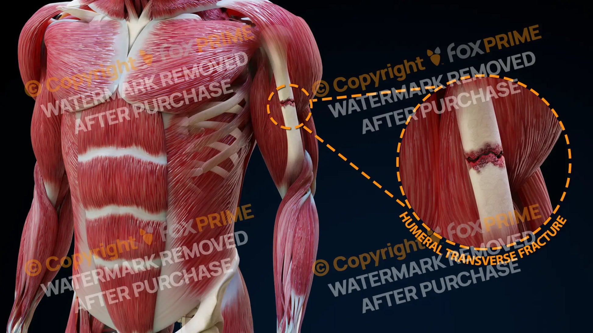 Left Humeral Transverse Fracture Single Use / Male Still Shot