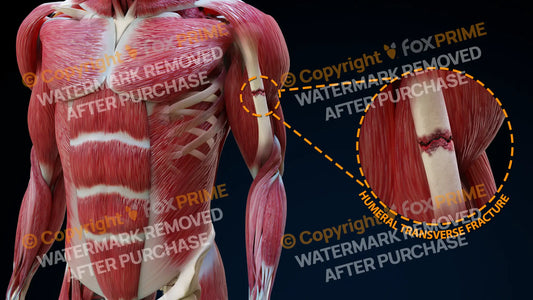 Left Humeral Transverse Fracture Single Use / Male Still Shot