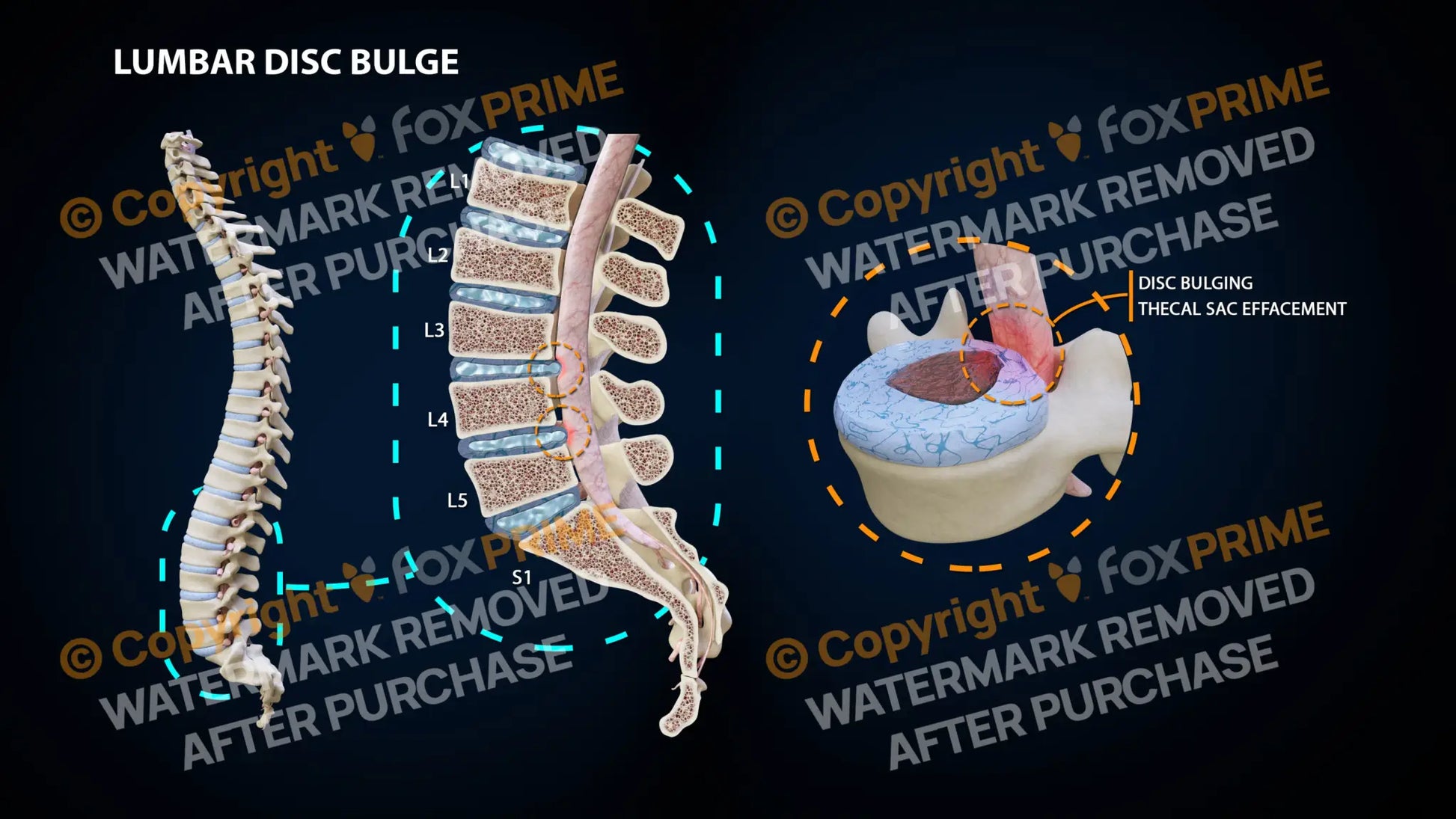 Lumbar Disc Bulge L3-4 L4-5 Still Shot