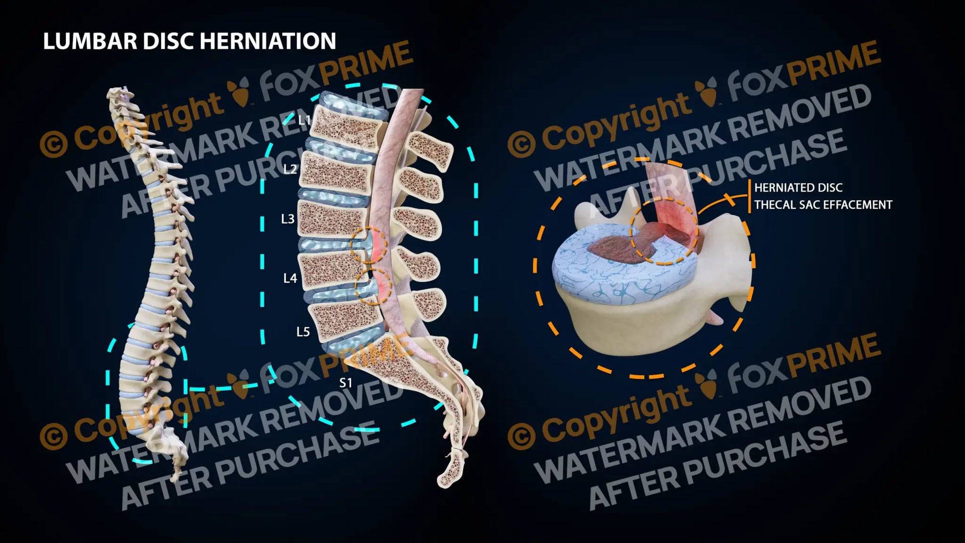 Lumbar Herniation L3-4 L4-5 Still Shot