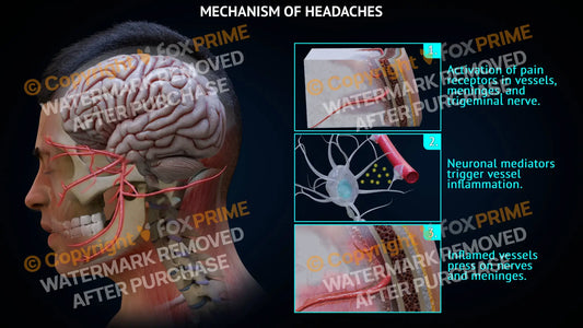 Mechanism of Headache Still Shot