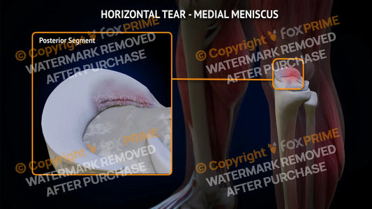 Medial Meniscus Tear - Horizontal Left Leg Type 3 Still Shot
