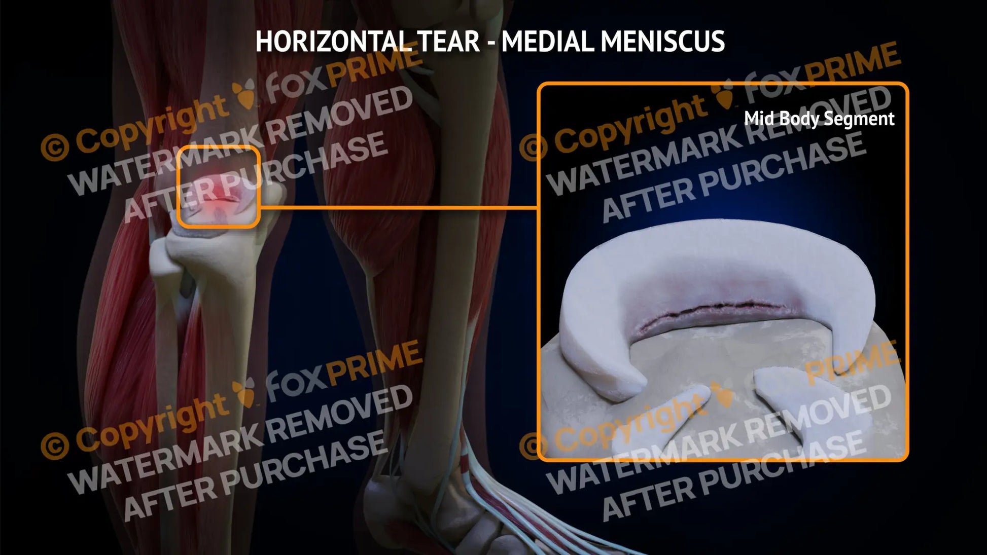 Medial Meniscus Tear - Horizontal Right Leg Type 1 Still Shot