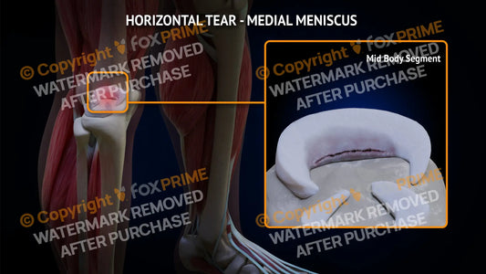 Medial Meniscus Tear - Horizontal Right Leg Type 1 Still Shot