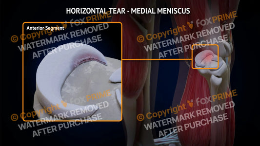 Medial Meniscus Tear - Horizontal Right Leg Type 2 Still Shot
