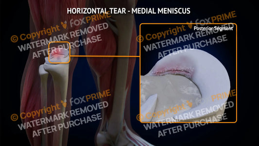Medial Meniscus Tear - Horizontal Right Leg Type 3 Still Shot