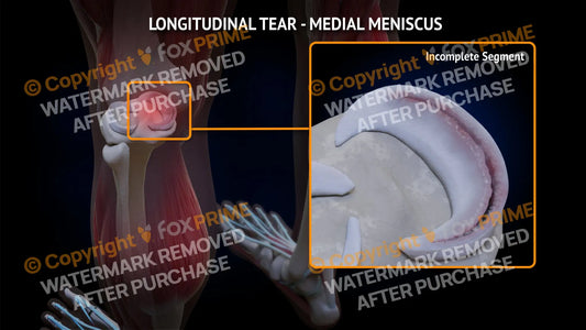 Medial Meniscus Tear - Longitudinal Left Leg Type 2 Still Shot