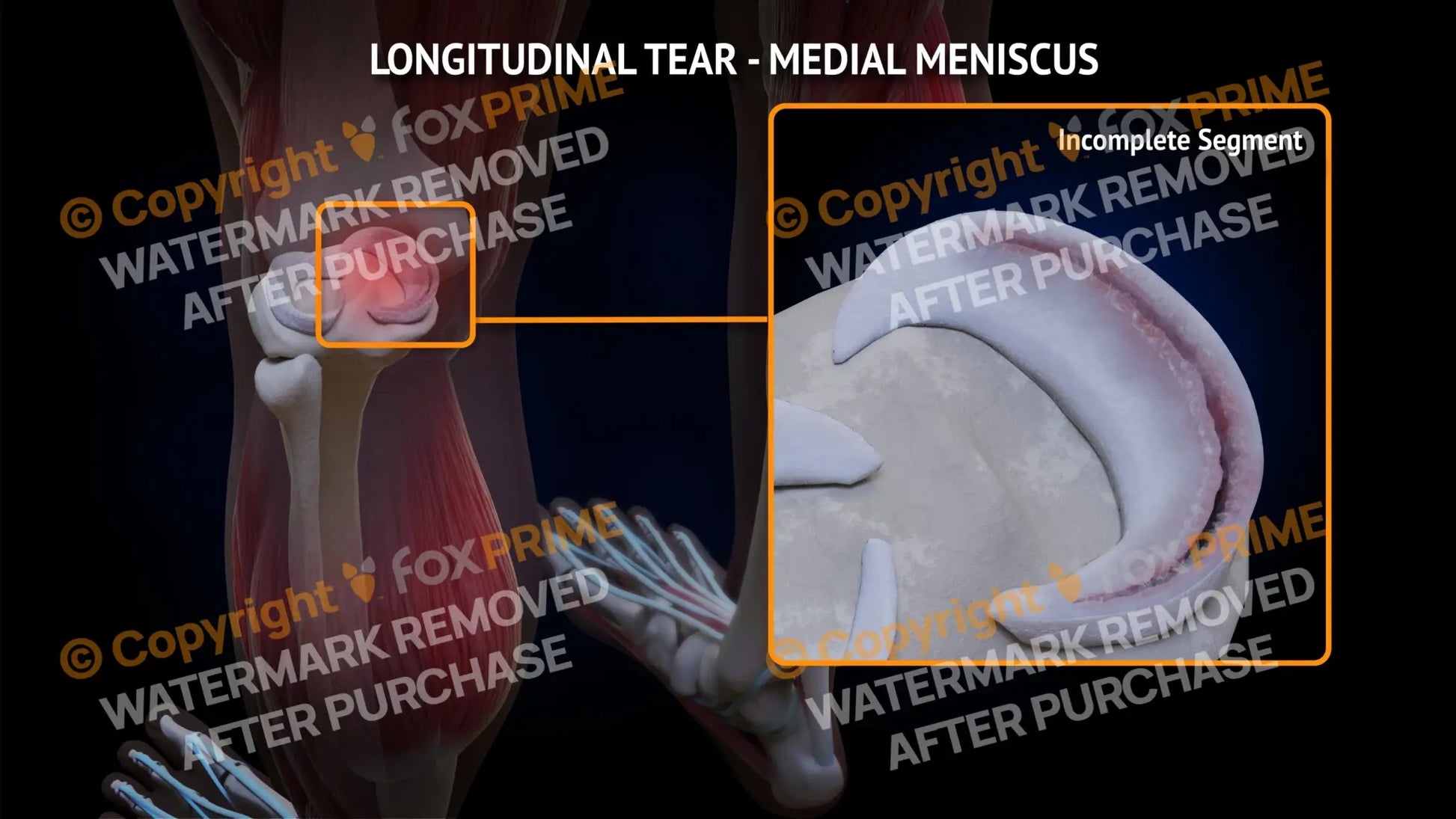 Medial Meniscus Tear - Longitudinal Left Leg Type 2 Still Shot