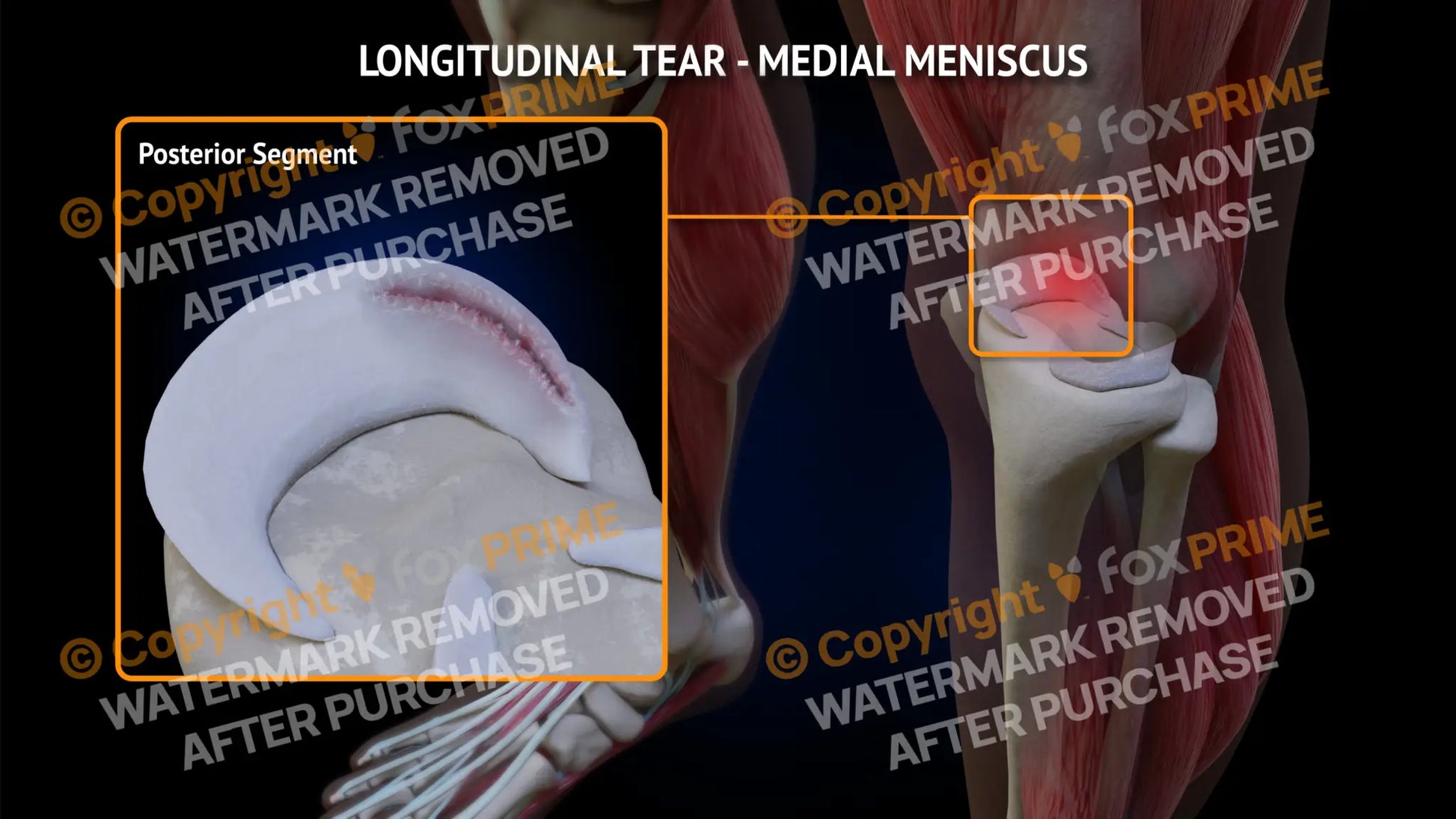 Medial Meniscus Tear - Longitudinal Left Leg Type 3 Still Shot