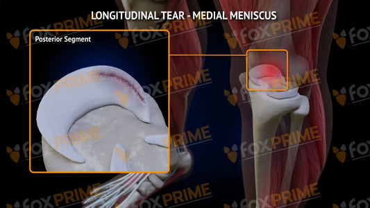 Medial Meniscus Tear - Longitudinal Left Leg Type 3 Still Shot