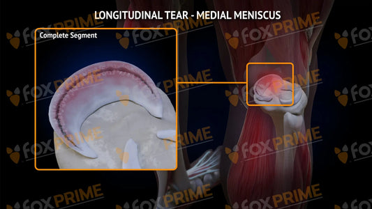 Medial Meniscus Tear - Longitudinal Right Leg Type 1 Still Shot