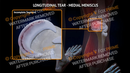 Medial Meniscus Tear - Longitudinal Right Leg Type 2 Still Shot