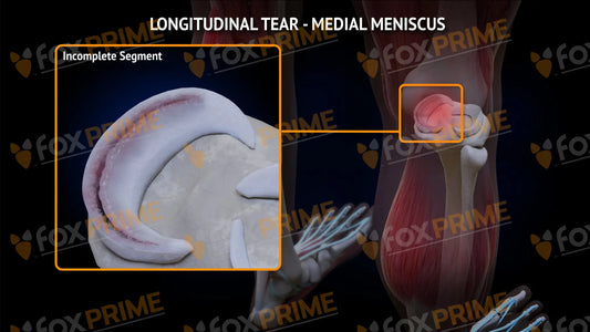 Medial Meniscus Tear - Longitudinal Right Leg Type 2 Still Shot