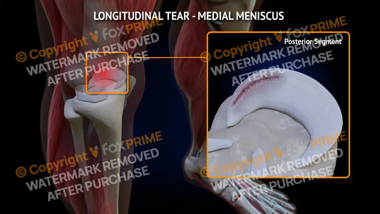 Medial Meniscus Tear - Longitudinal Right Leg Type 3 Still Shot