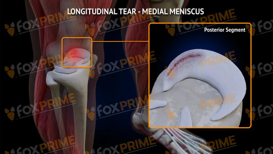 Medial Meniscus Tear - Longitudinal Right Leg Type 3 Still Shot