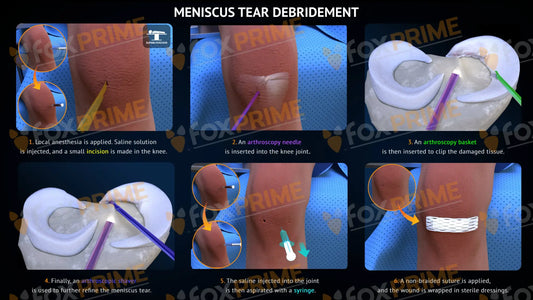 Meniscus Tear Debridement Surgery Single Use / Light Still Shot