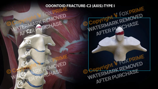 Odontoid Fracture C2 (Axis) - Type I Still Shot