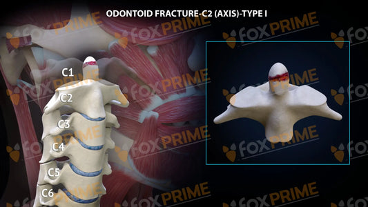 Odontoid Fracture C2 (Axis) - Type I Still Shot