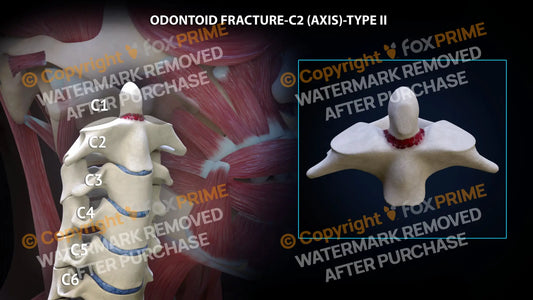 Odontoid Fracture C2 (Axis) - Type Ii Still Shot