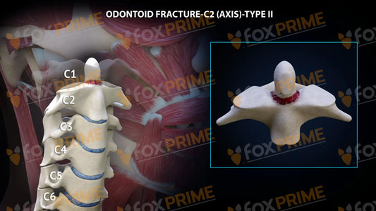 Odontoid Fracture C2 (Axis) - Type Ii Still Shot