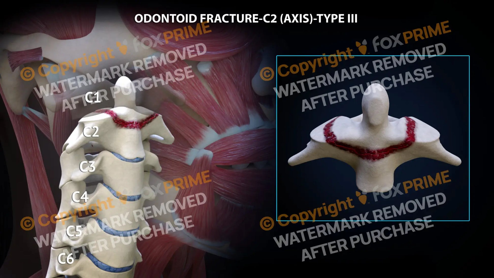 Odontoid Fracture C2 (Axis) - Type Iii Still Shot