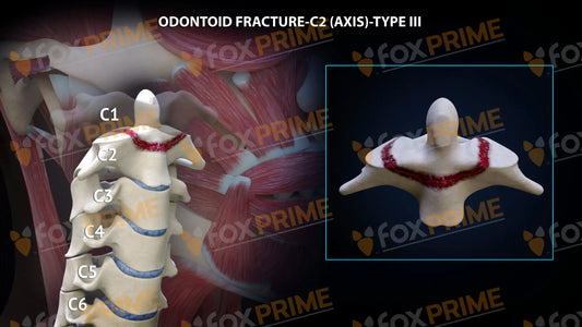 Odontoid Fracture C2 (Axis) - Type Iii Still Shot