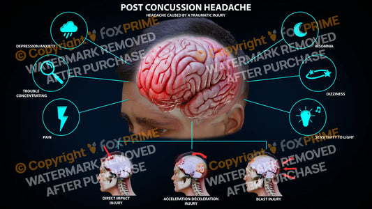 Post Concussion Headache Still Shot