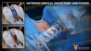 Anterior Cervical Discectomy and Fusion Left C4-C5 (Animation)