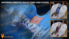 Anterior Cervical Discectomy and Fusion Right C5-C6 (Animation)