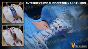 Anterior Cervical Discectomy and Fusion Left C2-C3 (Animation)