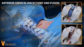 Anterior Cervical Discectomy and Fusion Right C2-C3 (Animation)