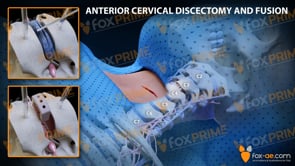 Anterior Cervical Discectomy and Fusion Left C3-C4 (Animation)