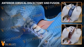 Anterior Cervical Discectomy and Fusion Right C4-C5 (Animation)