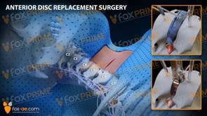 Anterior Disc Replacement Surgery C5-C6 (Animation)