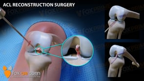 ACL Reconstruction Left (Animation)