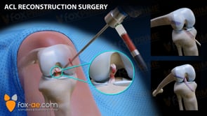 ACL Reconstruction Right (Animation)