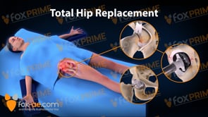 Total Hip Replacement Right (Animation)