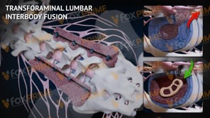 Transforaminal Lumbar Interbody Fusion L3-S1 (Animation)