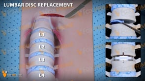 Lumbar Disc Replacement Left (Animation)