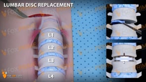 Lumbar Disc Replacement Right (Animation)