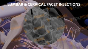 Lumbar and Cervical Facet Injections (Animation) – FoxPrime