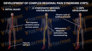 Complex Regional Pain Syndrome - CRPS  - Left Foot (PowerPoint)