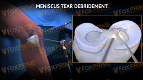 Meniscus Tear Debridement (Animation)