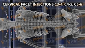 Cervical Facet Injections C3-4 C4-5 C5-6 (Animation)