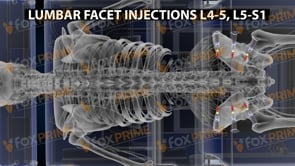 Lumbar Facet Injections L4-5 L5-S1 (Animation)