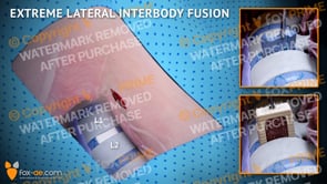 Extreme Lateral Interbody Fusion L1-L2 Left (Animation)