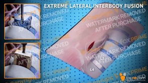 Extreme Lateral Interbody Fusion L3-L4 Right (Animation)