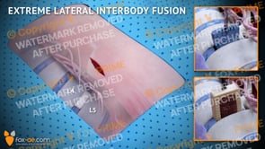 Extreme Lateral Interbody Fusion L4-L5 Left (Animation)