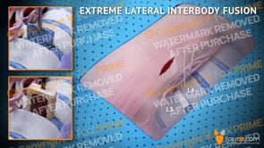 Extreme Lateral Interbody Fusion L4-L5 Right (Animation)